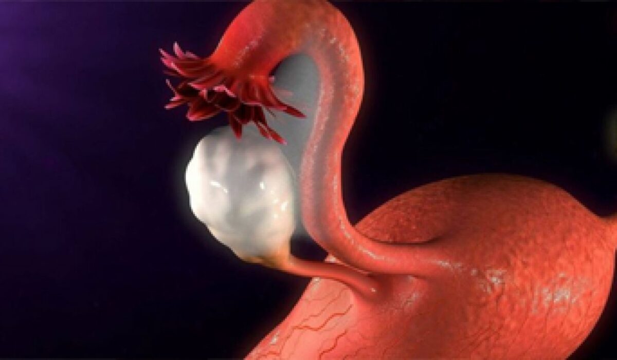 Endometriose – O que é, Causas, Sintomas e Tratamentos
